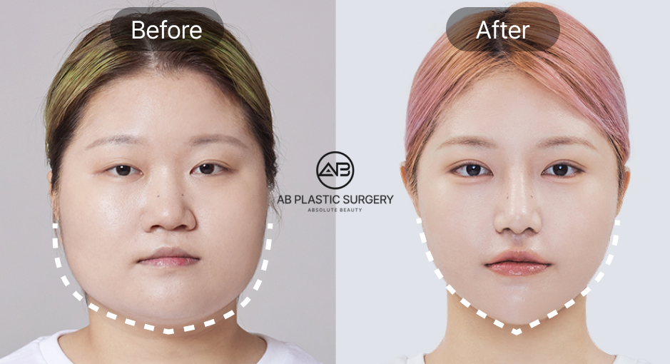 Korean Square Jaw Reduction Surgery Before and After