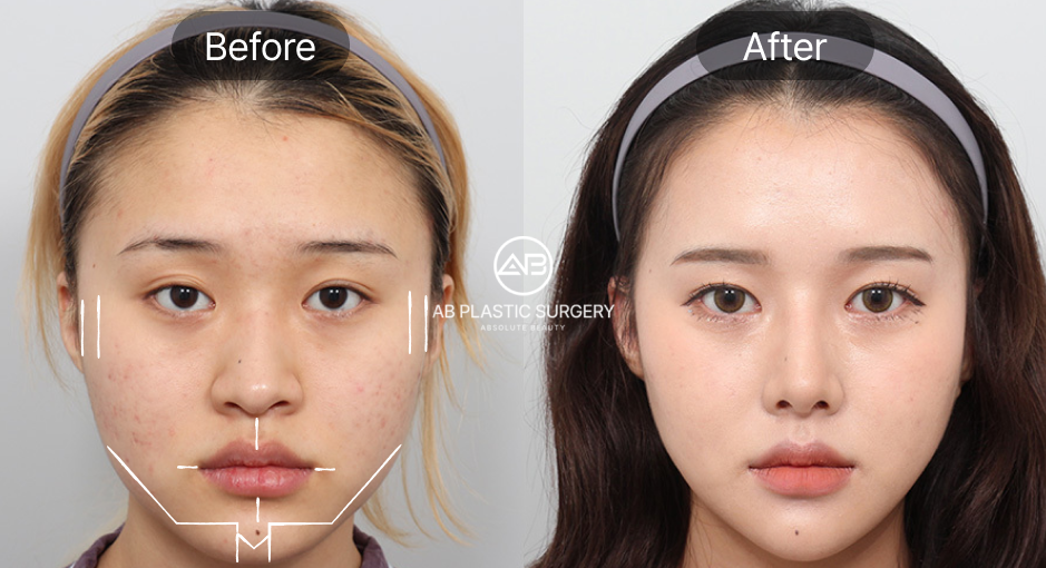 South Korea Facial Contouring Before and After Photo: Square Jaw Reduction and Chin Reduction