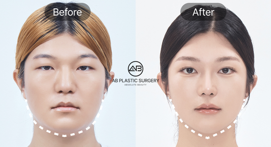 South Korea V-Line Surgery Before and After Photo
