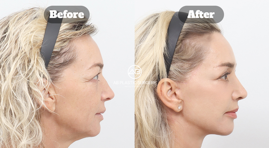 Full Facelift Before and After Photo at a Plastic Surgery Clinic in Korea