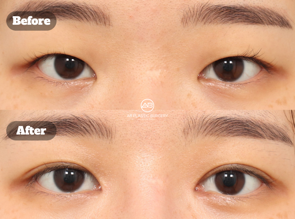 Eye Surgery Before and After in Korea with Non-Incisional Correction