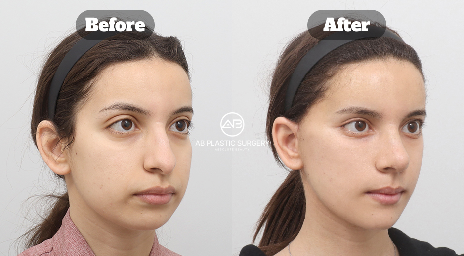 Ponytail Lift Before and After Photo in Korea