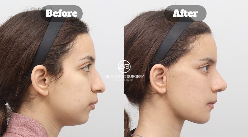 Ponytail Lift Before and After Results at AB Plastic Surgery in Korea
