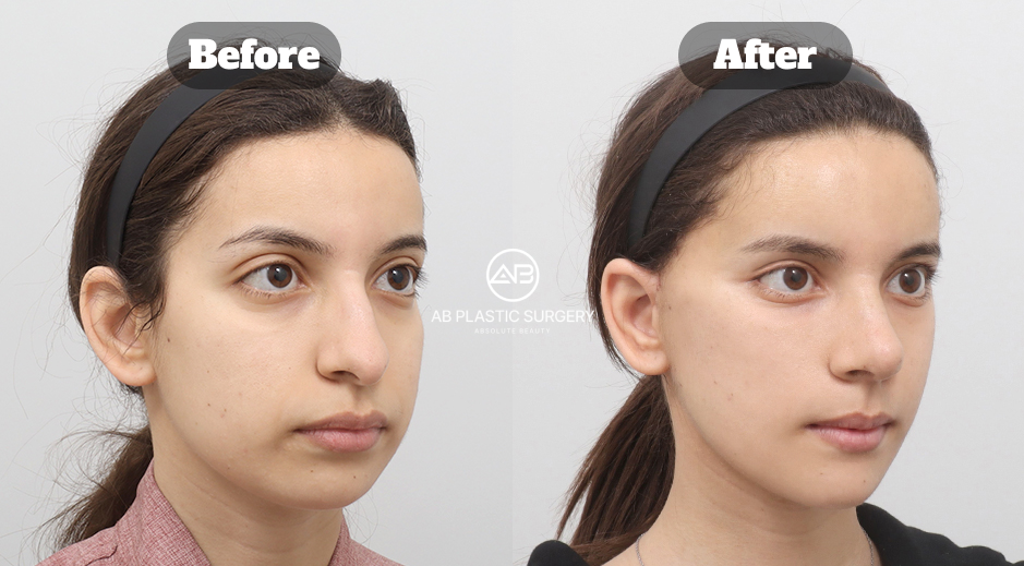 Ponytail Lifting Before and After Review in South Korea