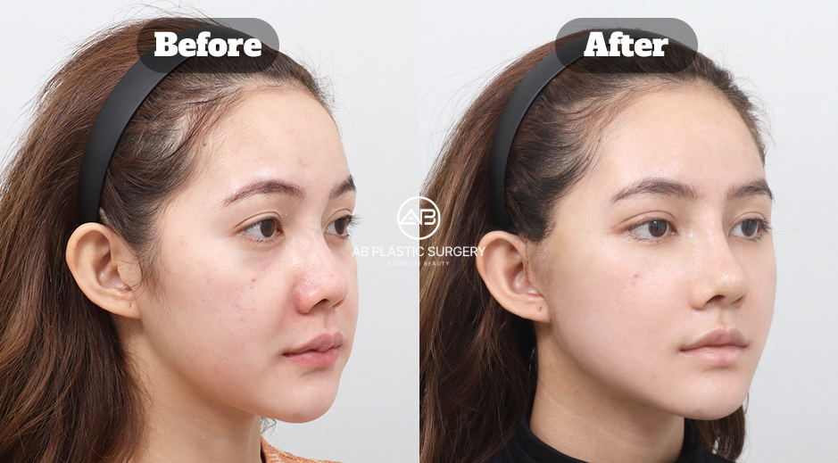 Mini Facelift Review in South Korea