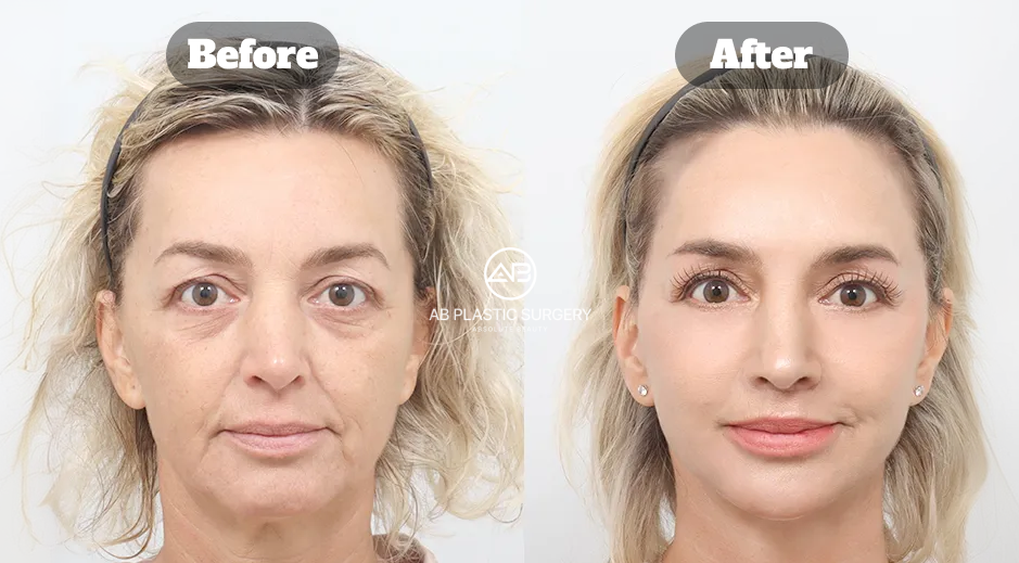 Full Facelift Before and After Results in Korea