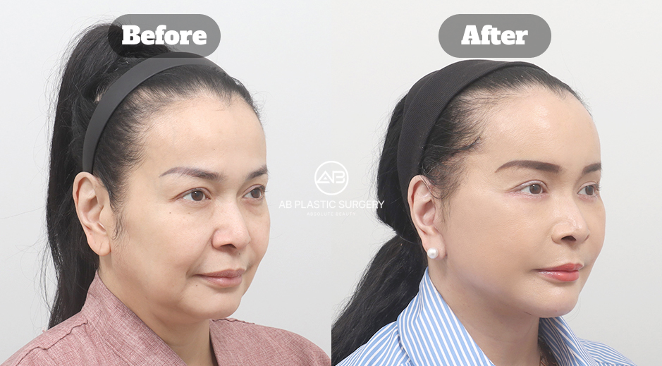 Before and After Results of Full SMAS Facelift with Neck Lift, Double Chin Liposuction, and Facial Fat Grafting in South Korea