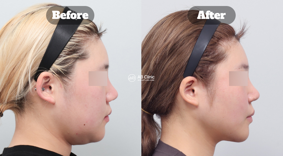 Before and After Results of Fat Dissolving Filler Treatment at AB Dermatology in South Korea