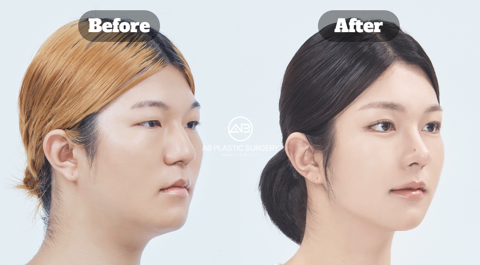 Before and After Results of Jaw, Cheekbone, and Chin Contouring Surgery in South Korea