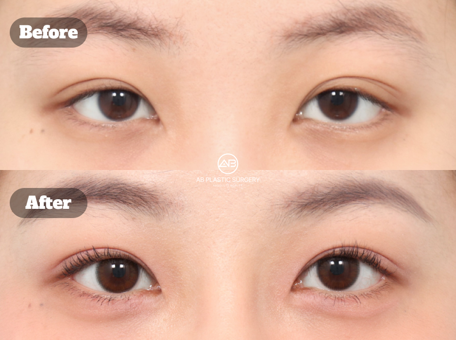 Clinical before and after image of non-incisional eyelid correction combined with epicanthoplasty