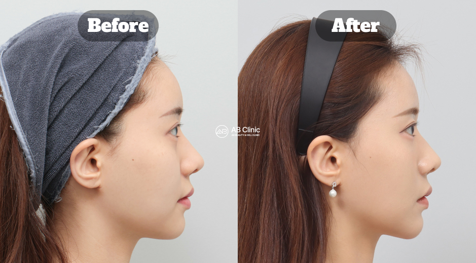 Before and After Results of Ultherapy, Shrink Lifting, and Chin Filler Treatment in Korea