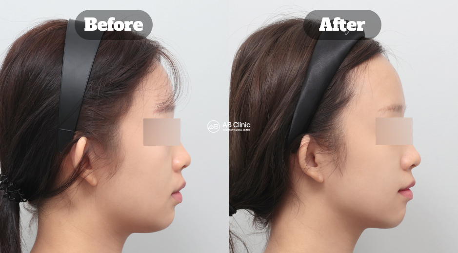 Before and After Results of Fat Dissolving Filler Treatment at AB Dermatology in Korea