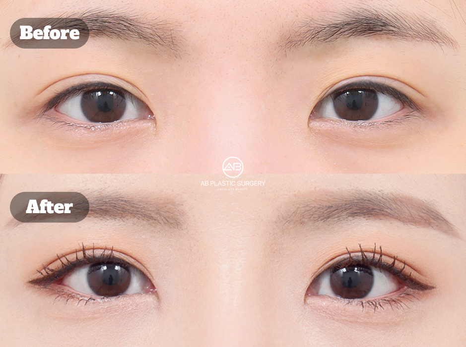 Clinical before and after image of lateral canthoplasty combined with lower canthoplasty