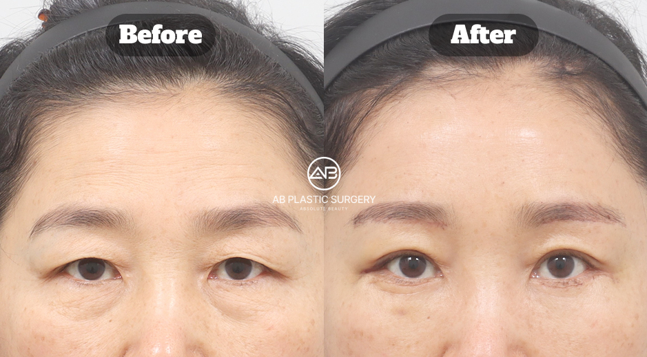 Before and after comparison of female forehead lift combined with lower blepharoplasty