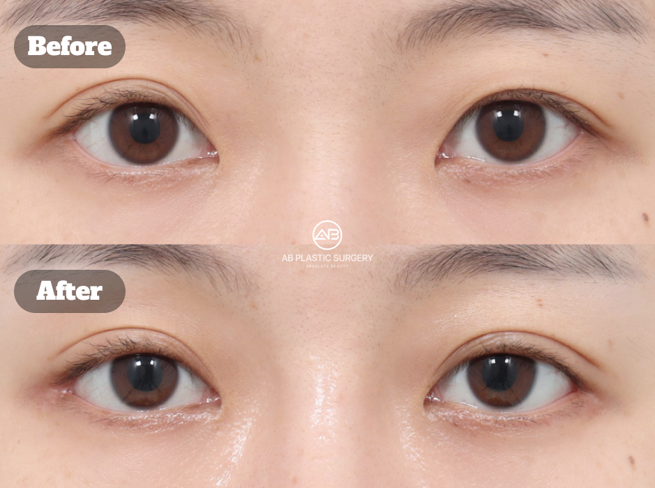 Clinical before and after image of non-incisional eyelid correction combined with lateral and lower canthoplasty