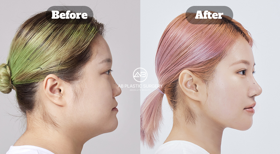 Before and After Results of Jaw, Cheekbone, and Chin Contouring with AccuSculpt and Double Chin Muscle Tightening in Korea