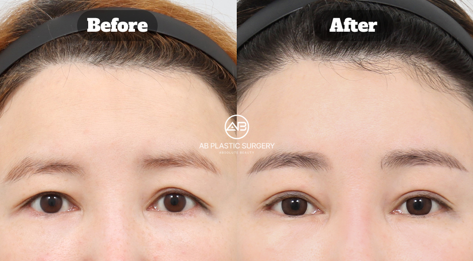 Before and after review of female forehead lift combined with non-incisional ptosis correction