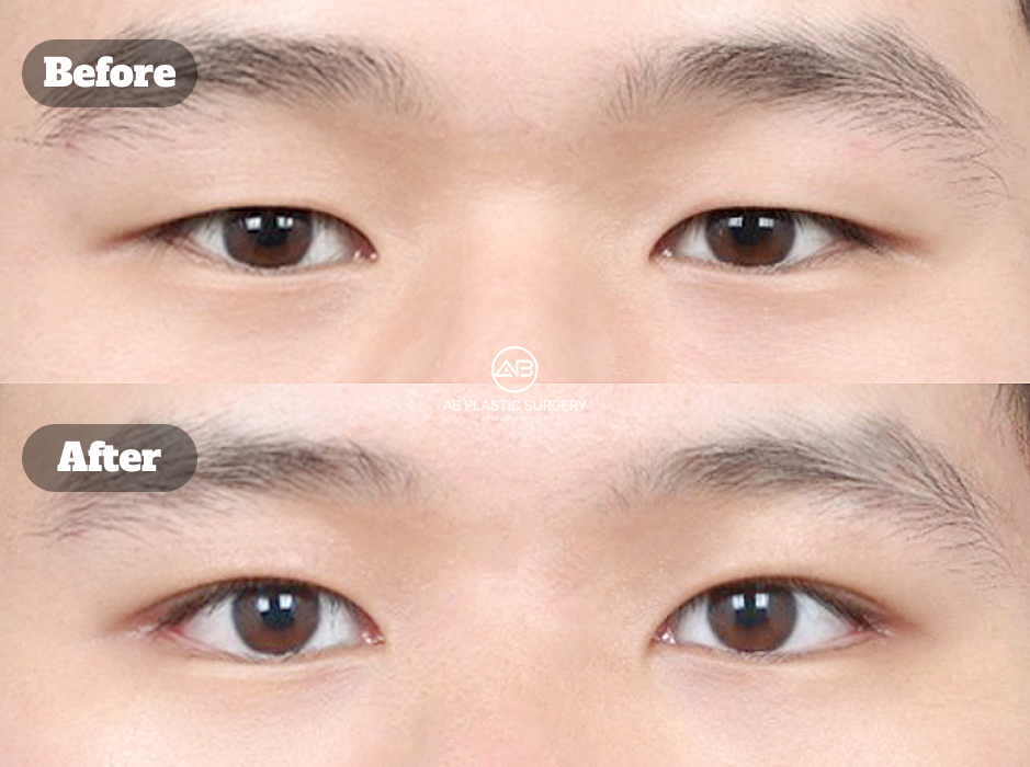 Clinical before and after image of male non-incisional eyelid correction combined with lateral and lower canthoplasty