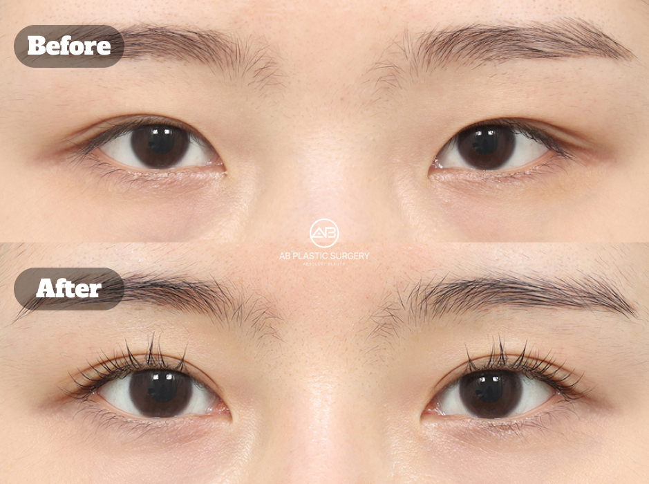 Clinical before and after image of revision non-incisional eyelid correction combined with epicanthoplasty