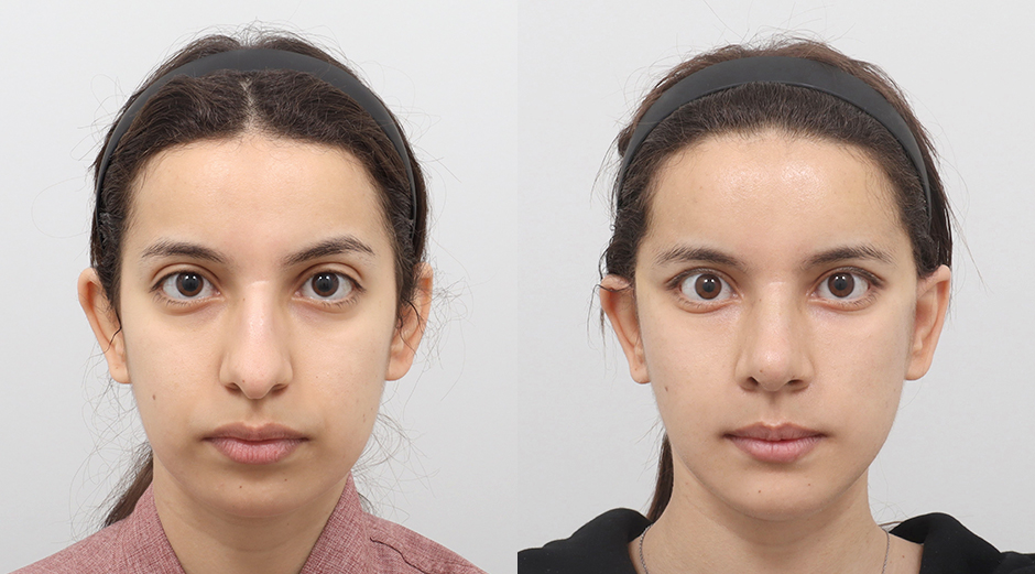 Korea Plastic Surgery Before and After | AB Plastic Surgery