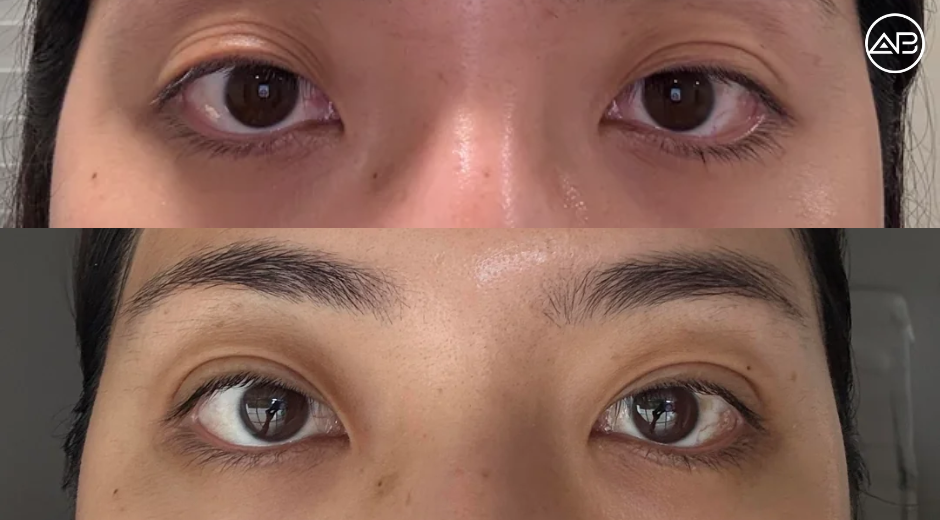 Double Eyelid Surgery Review - 1 Month Post OP