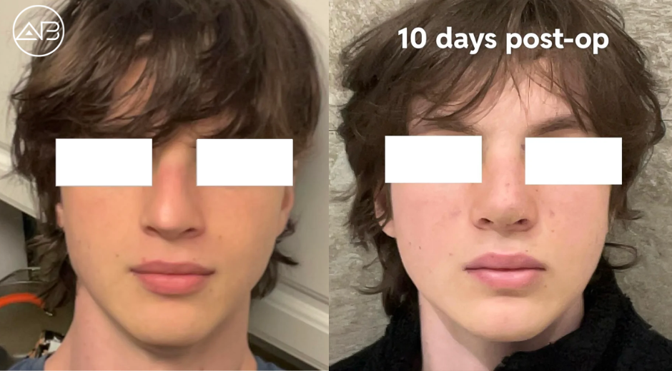 My Rhinoplasty Experience with AB Plastic Surgery