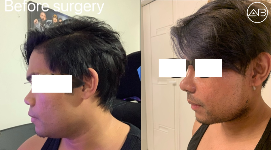 My experience with AB Plastic Surgery (Before / Cast Removal / 2 Weeks Post-Op) Rhinoplasty+ thread Lift + Accu